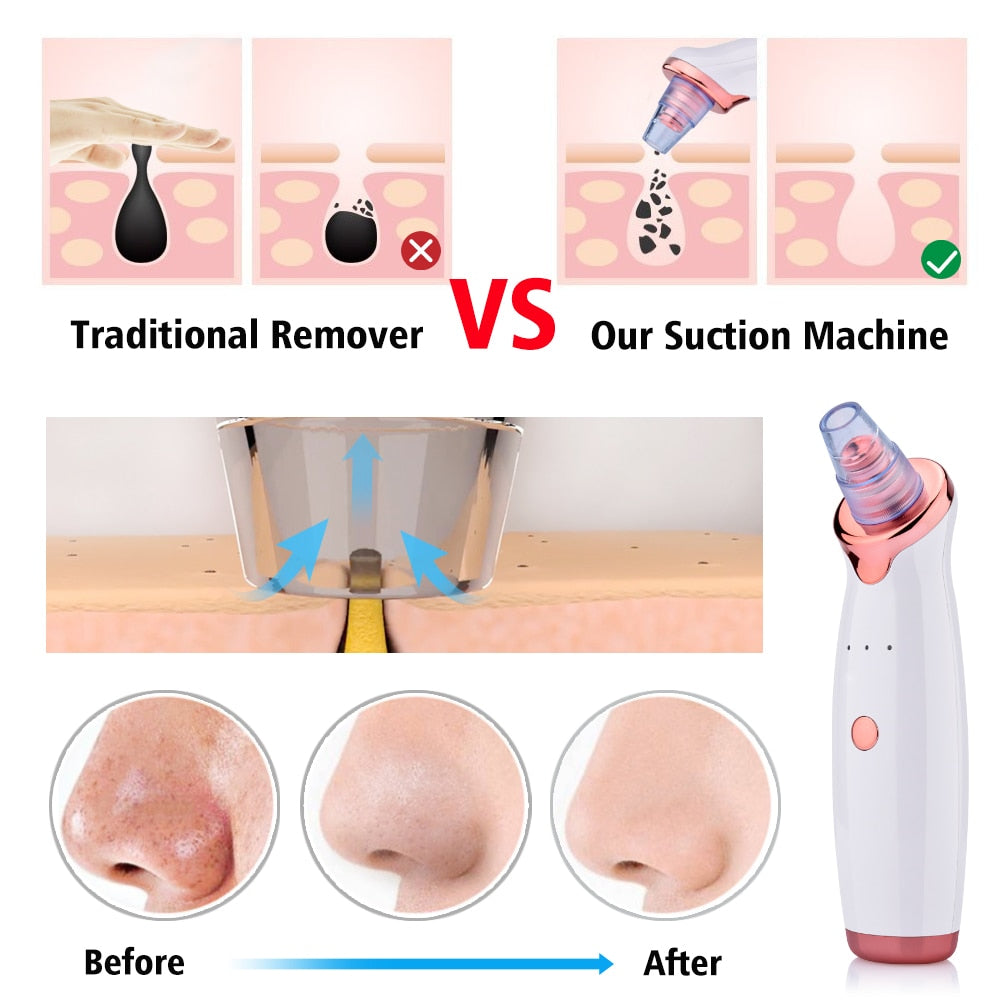Blackhead and Acne Cleaning & Suction Instrument
